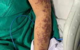 Đắk Lắk ghi nhận thêm 1 ca nhiễm liên cầu lợn