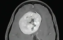 Mắc bệnh tâm thần liên quan đến u não
