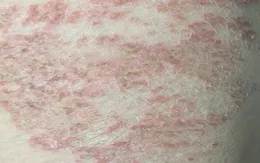 Người đàn ông nhiễm ký sinh trùng do thói quen cho thú cưng ngủ cùng