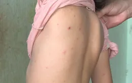 Đắk Lắk ghi nhận ổ dịch thủy đậu tại một trường mầm non