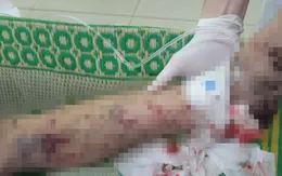 Nam thanh niên phải cắt bỏ cổ tay, nguy cơ mù mắt phải do pháo tự chế nổ