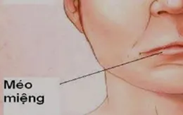Bé gái 4 tuổi liệt dây thần kinh số 7 ngoại biên và cảnh báo của bác sĩ