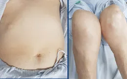 Cảnh báo hội chứng Cushing do lạm dụng thuốc corticoid