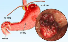 Cảnh giác với viêm loét dạ dày do vi khuẩn HP ở trẻ em