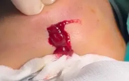 Nhiễm trùng sau khi tiêm filler: Lời cảnh tỉnh cho việc làm đẹp tại cơ sở không uy tín
