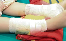 Bé gái bị bỏng nặng do nghịch cồn