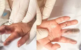 Bé gái bị dập nát ngón tay do máy thêu của gia đình