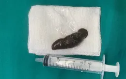 Gắp con đỉa ký sinh trong khí quản bệnh nhân