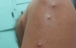 Phát hiện 1 trường hợp nghi mắc đậu mùa khỉ, Cà Mau tăng cường phòng chống dịch