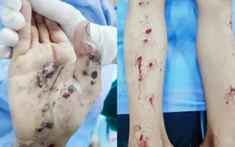 Một học sinh bị găm 15 mảnh thuỷ tinh vào người do pháo tự chế phát nổ