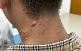 Đồng Nai thêm 1 ca nghi mắc bệnh đậu mùa khỉ