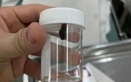 Bé gái bị vắt ký sinh trong mũi sau chuyến dã ngoại cùng gia đình