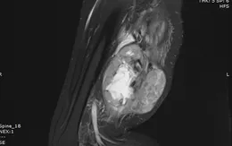 Cắt bỏ khối sarcoma sụn ác tính hiếm gặp, bảo toàn chi cho bệnh nhân