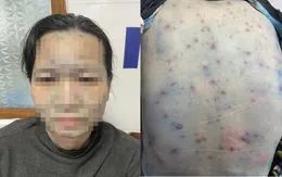 Nhiều bệnh nhân có bệnh lý nền nội tiết mắc bệnh thủy đậu có biến chứng nặng