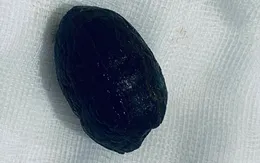 Tắc ruột do nuốt quả ô mai
