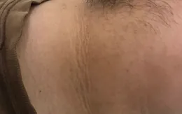 Gầy sút 20kg trong một tháng, đi khám phát hiện mắc đái tháo đường