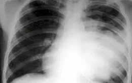 Cảnh báo gia tăng viêm phổi do vi khuẩn Mycoplasma ở trẻ nhỏ