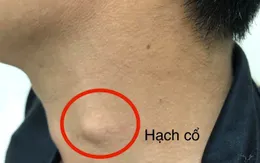 Phát hiện mắc ung thư thực quản sau thời gian bị nuốt nghẹn, gầy sút cân