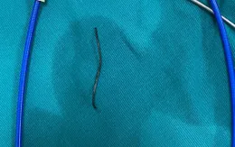 Gắp cọng kẽm dài 3cm trong dạ dày bệnh nhân