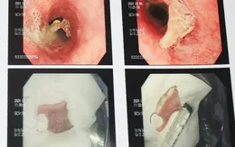 Kịp thời lấy hàm răng giả mắc kẹt trong thực quản bệnh nhân 68 tuổi ở Bạc Liêu