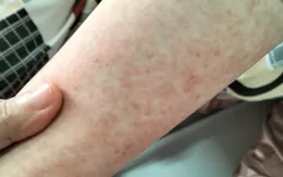 Mắc dị ứng thể hiếm gặp, tỷ lệ 1/100.000 ca do tự uống thuốc điều trị