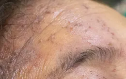 Cẩn trọng với bệnh zona thần kinh trong thời điểm giao mùa