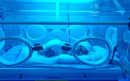 Thay máu cứu trẻ sơ sinh bị vàng da nặng