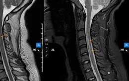 Nữ sinh 20 tuổi đột ngột bị yếu liệt tay sau khi ngủ dậy vì thói quen nhiều bạn trẻ mắc phải