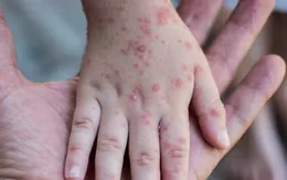 Bắc Kạn ghi nhận 1 trường hợp mắc rubella