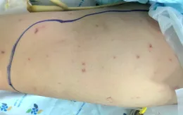 Bé gái nguy kịch vì viêm não mô cầu