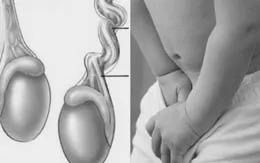 Khối căng phồng vùng bẹn - nguy hiểm ẩn chứa