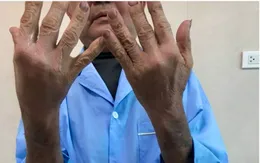 Suy tuyến thượng thận do điều trị bằng thuốc không rõ nguồn gốc tại nhà