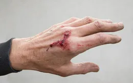 6 bước sơ cấp cứu vết thương chảy máu