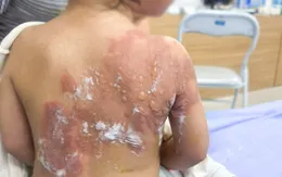 Nhiều trẻ bị bỏng nghiêm trọng do người lớn bất cẩn