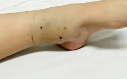 Cảnh báo tình trạng rắn cắn gia tăng trong mùa mưa