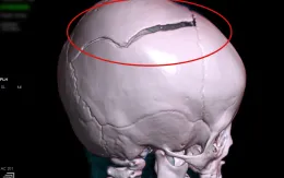 Bé gái bị chấn thương nặng do cánh cổng sắt đổ sập vào đầu