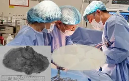 Đau bụng đi khám, phát hiện khối u thận to hiếm gặp