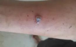 Bệnh than và cách phòng ngừa