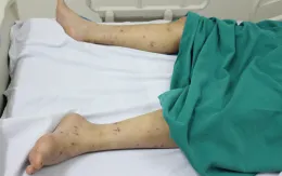 Những điều cần biết về viêm màng não mô cầu và cách dự phòng