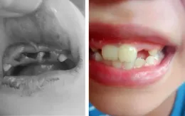 Phải làm gì khi trẻ bị ngã gãy răng?
