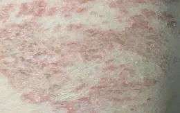 Mắc 6 loại giun, sán từ những thói quen phổ biến