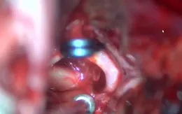 Cứu sống nữ du khách đột quỵ do vỡ dị dạng mạch não