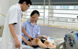 Cảnh báo hoại tử chân vì dùng ong đốt để chữa bệnh