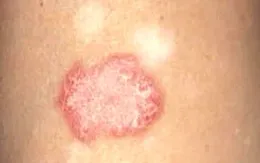 Lupus ban đỏ - Căn bệnh tự miễn thầm lặng và nguy hiểm