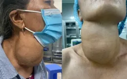 Khó thở, nuốt nghẹn vì bướu cổ nặng gần 1kg