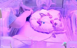 Cứu trẻ sinh non bị bệnh màng trong giai đoạn 4 kèm nhịp tim nhanh kịch phát