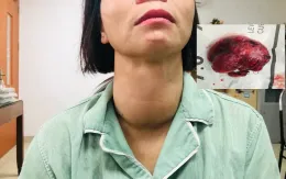 Cắt bỏ khối u giáp khổng lồ đeo bám người phụ nữ hơn 10 năm