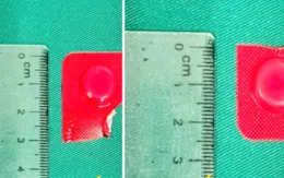 Cảnh giác với dị vật thuốc nguyên vỏ trong đường tiêu hóa trên