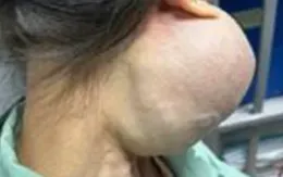 Trì hoãn 14 năm không điều trị, người phụ nữ suýt mất mạng vì khối u lớn trên mặt