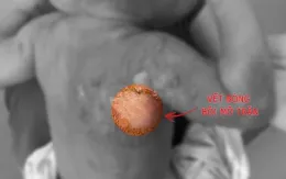 Trẻ bị bỏng không bôi mỡ trăn để tránh gây hậu quả nặng hơn